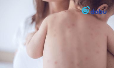 Улаанбурхан өвчний батлагдсан тохиолдол 8,648-д хүрч, нас баралт долоо болжээ