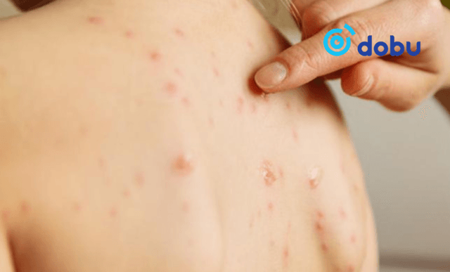 Улаанбурхан өвчний нийт батлагдсан тохиолдол 13 мянга болжээ