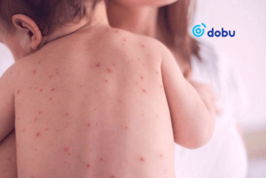 Улаанбурхан өвчний улмаас 24 иргэн эмнэлэгт хэвтэн эмчлүүлж байна