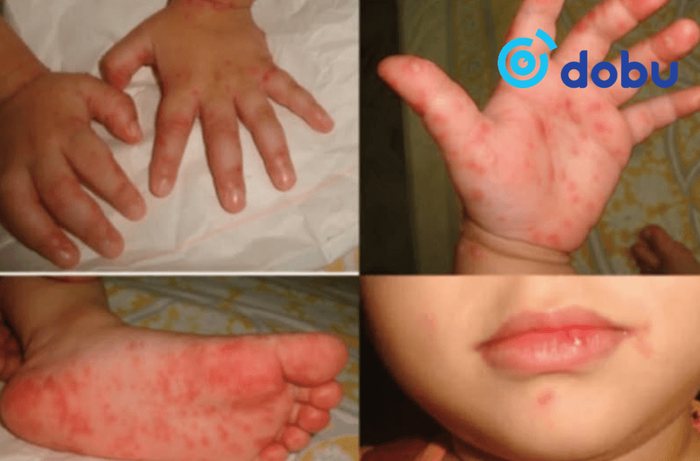 Гар, хөл, амны өвчин, янз бүрийн хүндрэл үүсгэдэг энтеровирус Тайваньд тархжээ