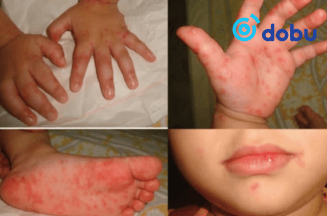 Гар, хөл, амны өвчин, янз бүрийн хүндрэл үүсгэдэг энтеровирус Тайваньд тархжээ