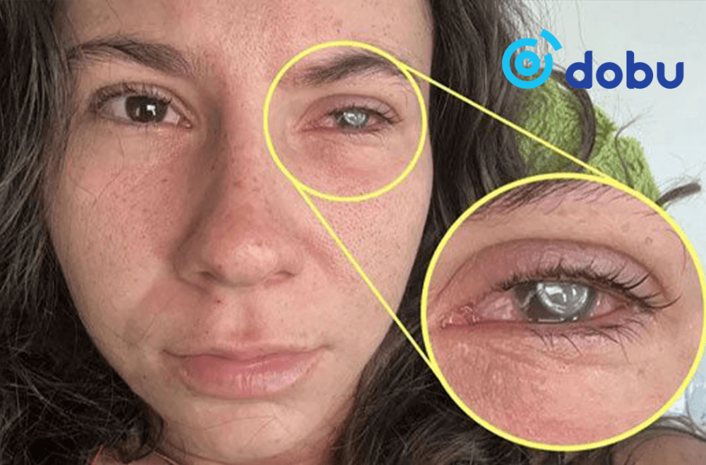 Контакт линз зөв хэрэглэхгүй бол хараагаа алдана