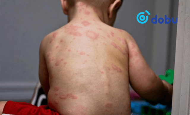 Менингоккокт халдвар авсан хүүхэд нас баржээ