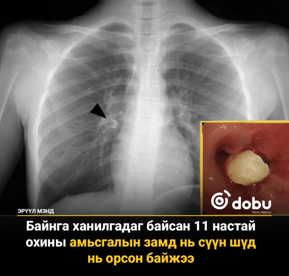 Сүүн шүд унахдаа хүүхдийн уушги руу орох аюултай