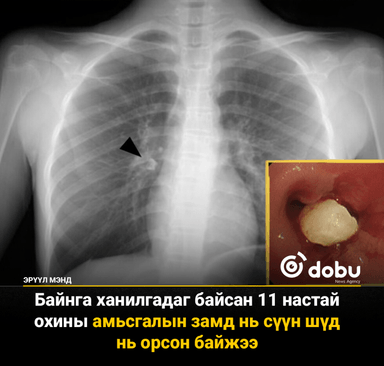 Сүүн шүд унахдаа хүүхдийн уушги руу орох аюултай