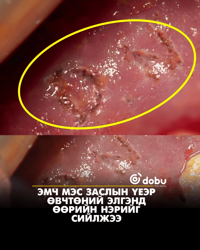 Эмч мэс заслын үеэр өвчтөний элгэнд өөрийн нэрийг сийлжээ