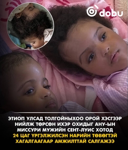 Толгойныхоо орой хэсгээр нийлж төрсөн Этиопын ихэр охидыг 24 цаг үргэлжилсэн нарийн төвөгтэй хагалгаагаар салгажээ