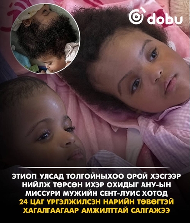 Толгойныхоо орой хэсгээр нийлж төрсөн Этиопын ихэр охидыг 24 цаг үргэлжилсэн нарийн төвөгтэй хагалгаагаар салгажээ