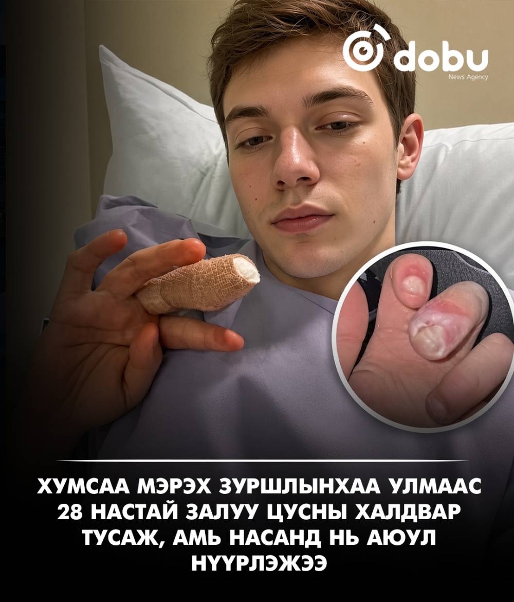 Хумсаа мэрдэг зуршлаасаа болж цусны халдвар авч, амь насанд нь аюул учирчээ