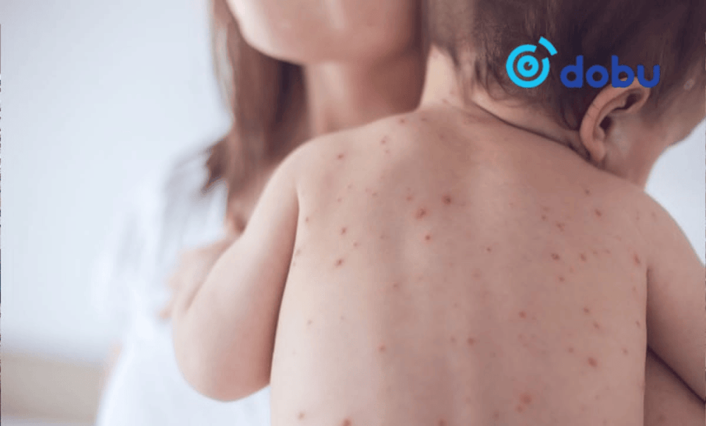 Улаанбурхан өвчний 516 тохиолдол лабораториор батлагдлаа