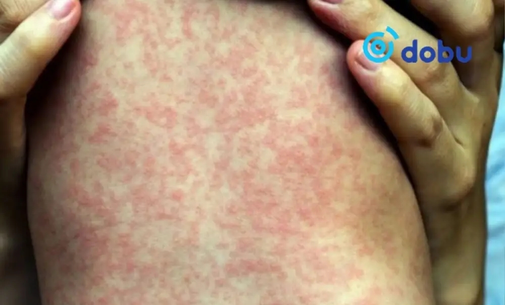 Улаанбурханы өвчлөл нэг хоногт 18 тохиолдлоор нэмэгджээ