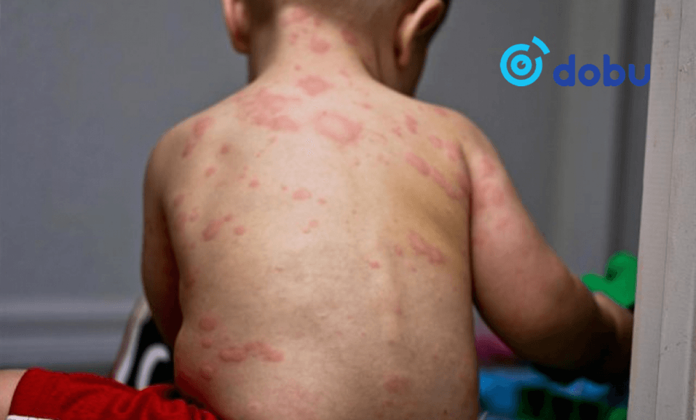 Менингоккокт халдвар авсан хүүхэд нас баржээ