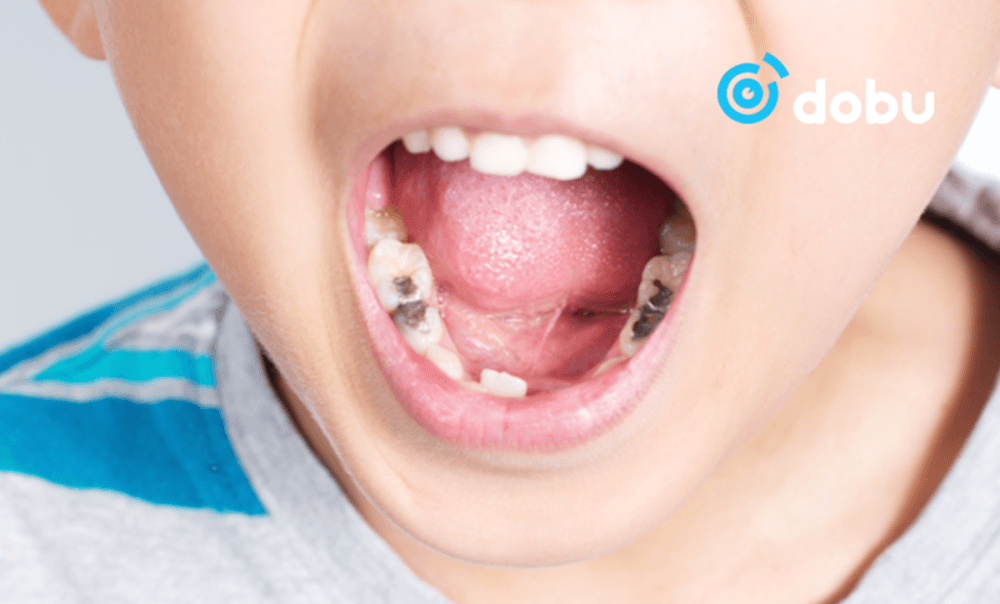 Эрт илрүүлэгт хамрагдсан хүүхдүүдийн 80 хувь нь шүдний цооролтой байна