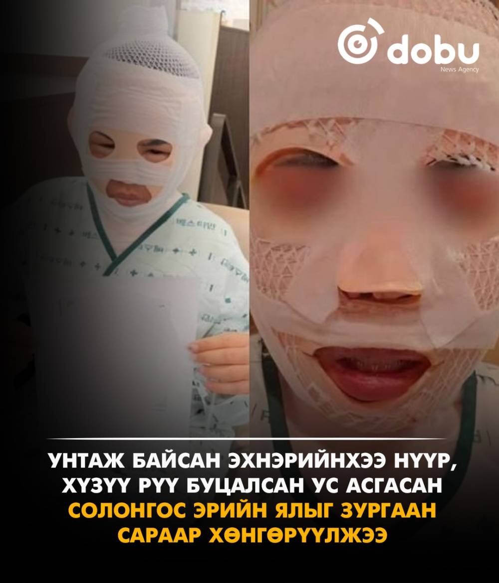 Эхнэрийнхээ нүүр, хүзүүг буцалсан усаар түлсэн эрийн ялыг зургаан сараар хөнгөрүүлэв