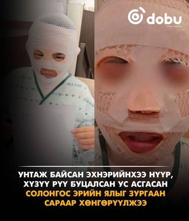 Эхнэрийнхээ нүүр, хүзүүг буцалсан усаар түлсэн эрийн ялыг зургаан сараар хөнгөрүүлэв